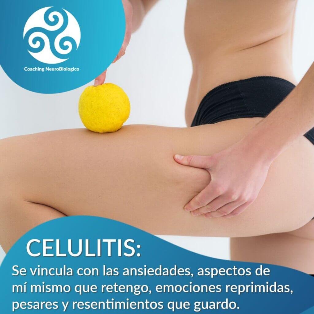 Celulitis