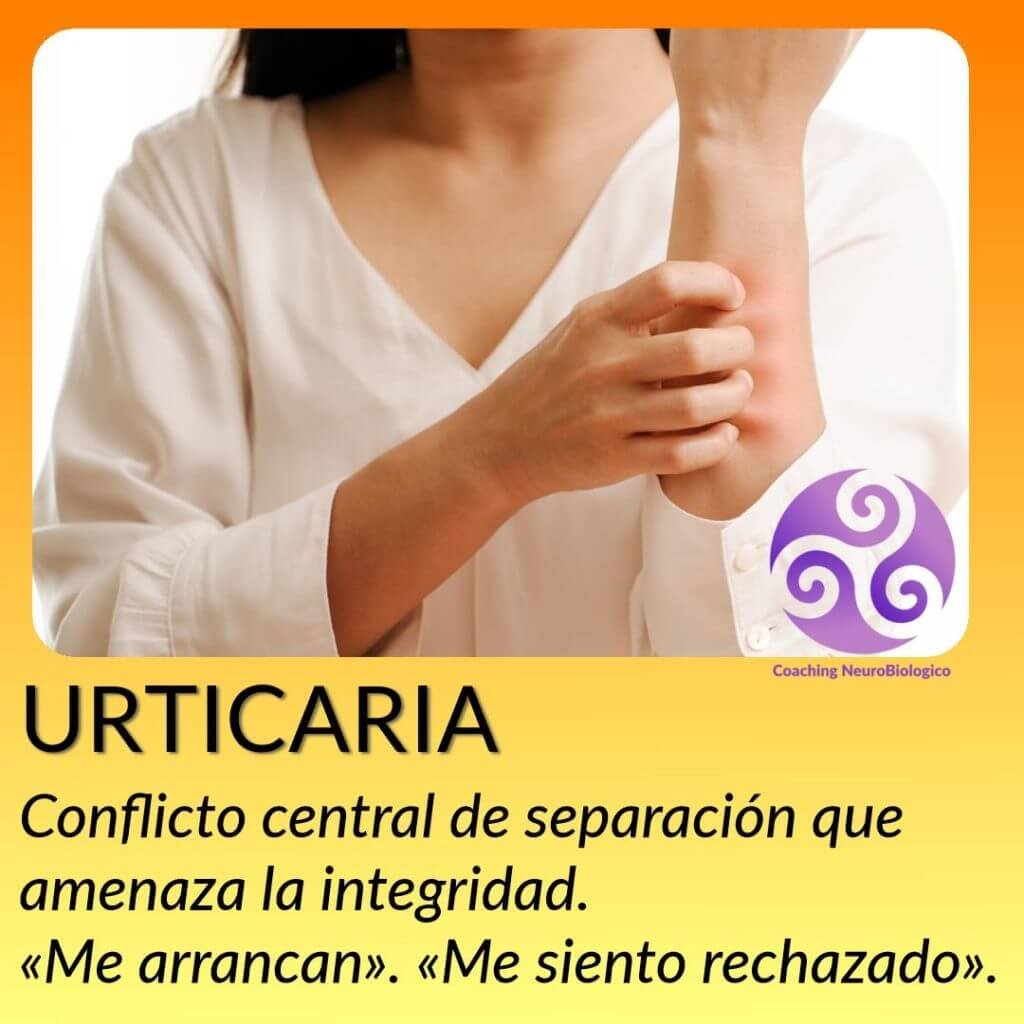 Urticaria