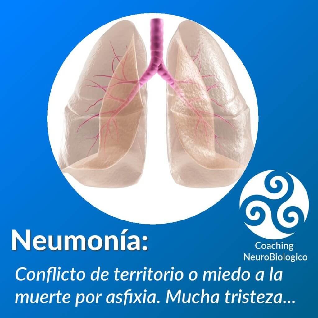 neumonia