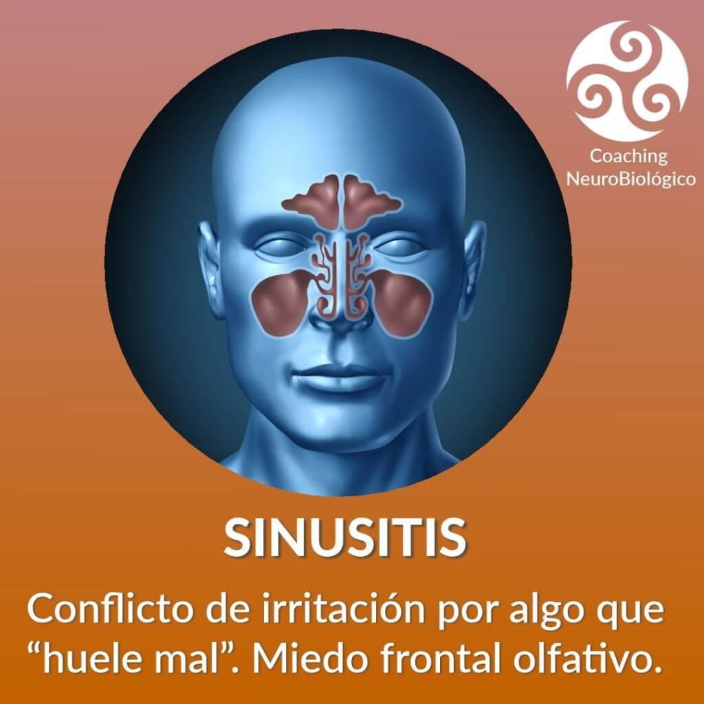 sinusitis