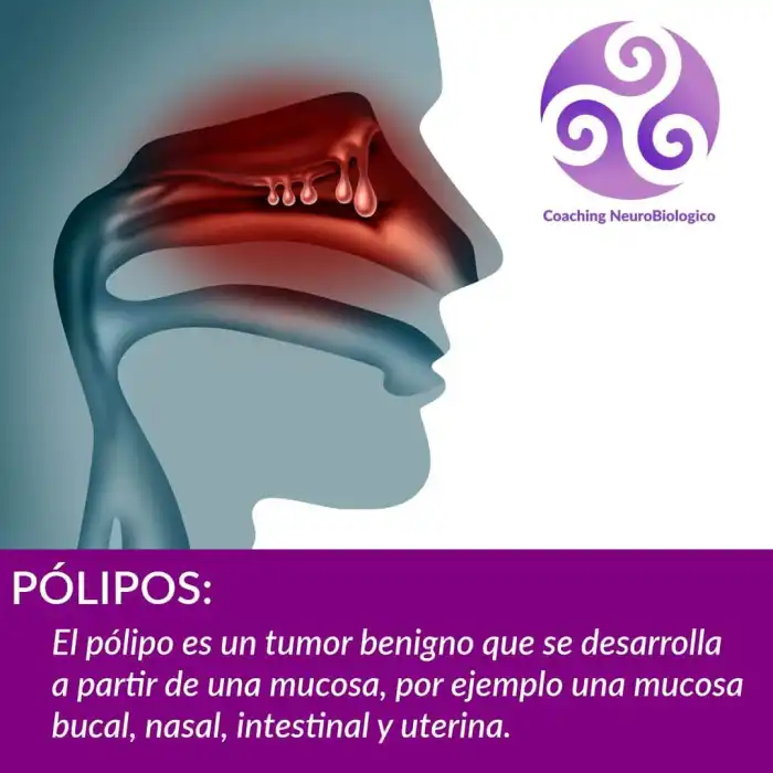 polipo: tumor benigno