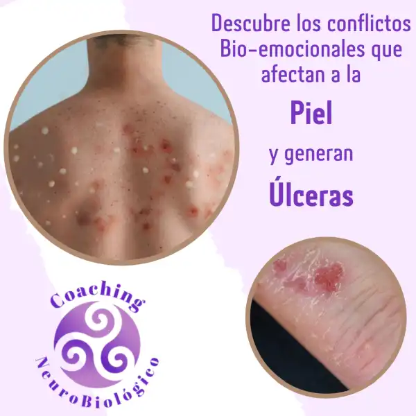 Piel_Ulcera